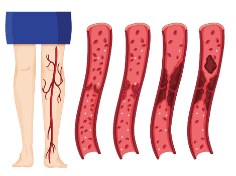 Afbeelding ontwikkeling trombose in been met uiteindelijk een stolsel dat losraakt