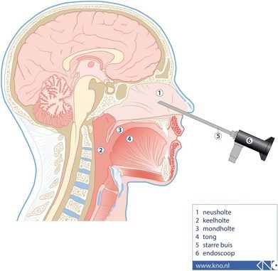 Doorsnede hoofd waarbij getoond wordt hoe een endoscopische operatie uitgevoerd wordt, met 1. de neusholte, 2. de keelholte, 3. de mondholte, 4. de tong, 5. de starre buis van de endoscoop en 6. de endoscoop