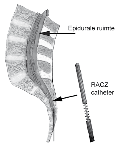 Afbeelding epidurale ruimte en RACZ-katheter