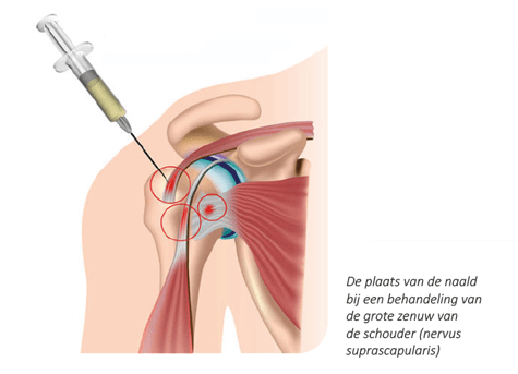 Doorsnede schouder waarin met een injectiespuit de plaats van de injectie bij een behandeling van de grote zenuw van de schouder (nervus suprascapularis) wordt weergegeven.